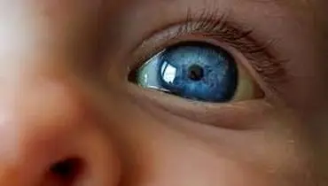 چرا چشمان نوزاد زرد است؟
