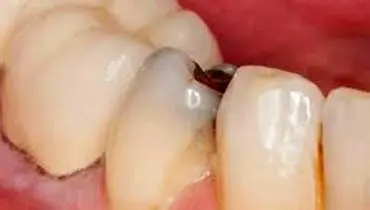 پوسیدگی دندان و هر آنچه لازم است در این مورد مهم بدانید
