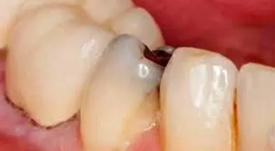 پوسیدگی دندان و هر آنچه لازم است در این مورد مهم بدانید
