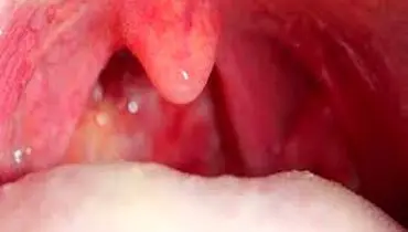 خلط گلو و پشت بینی شما را هم اذیت می کند؟