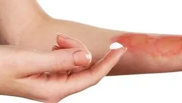 
این کارها را بلافاصله بعد از سوختگی انجام دهید