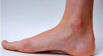 یک راهکار مناسب برای پیشگیری از واریس
