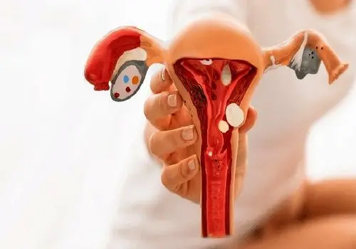 غذاهایی که مبتلایان به کیست تخمدان باید از آن‌ها پرهیز کنند
