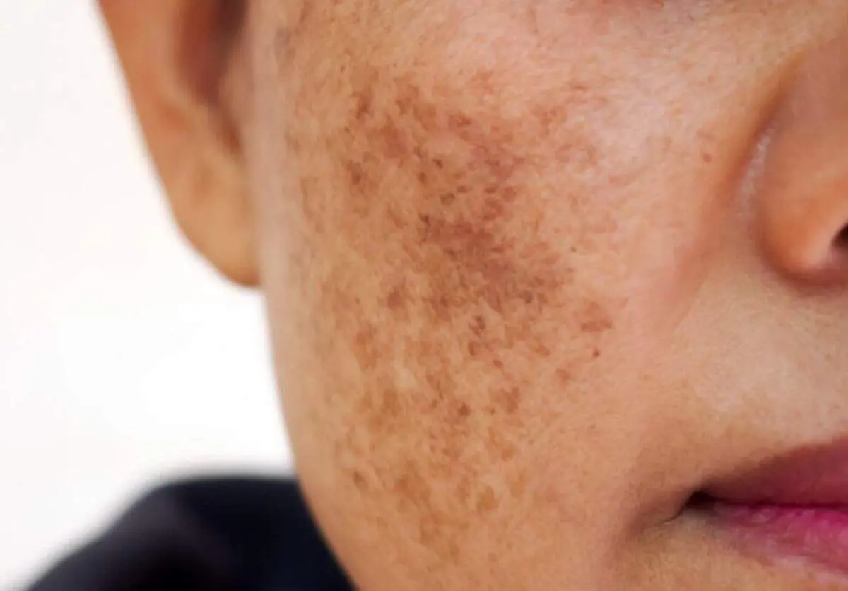 لکهای پوستی صورت شما را کلافه کرده است راه حل اینجاست
