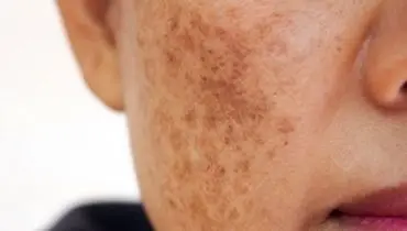 لک‌های پوستی صورت شما را کلافه کرده است راه حل اینجاست
