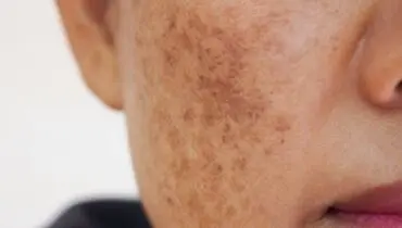 لک‌های پوستی صورت شما را کلافه کرده است راه حل اینجاست
