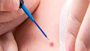 لیزر زگیل تناسلی، درمان سریع و بدون درد برای همه بیماران