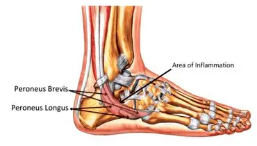 توصیه کارشناسان برای پیشگیری از آسیب تاندون‌ها
