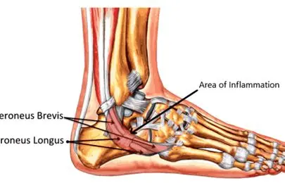 توصیه کارشناسان برای پیشگیری از آسیب تاندون‌ها

