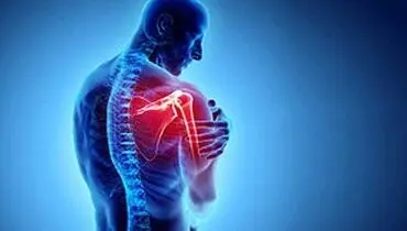 سندروم گیرافتادگی شانه چیست؟