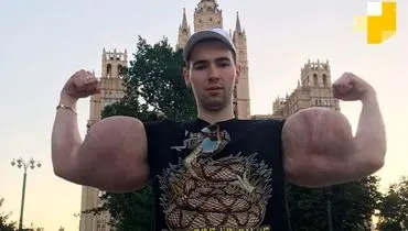 «ملوان زبل روسی» در آستانه قطع هر دو دست به دلیل عفونت ناشی از تزریق داروی بدنسازی