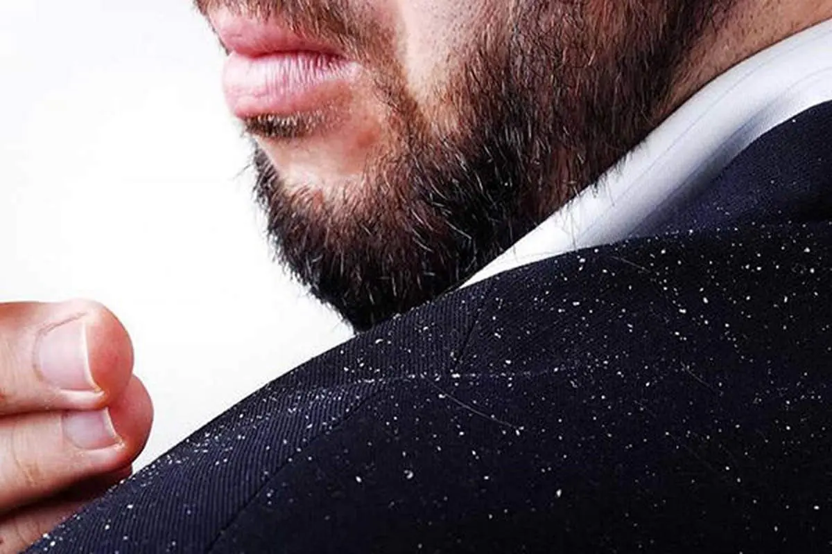این غذاها شوره سر را بدتر می کنند