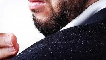این غذاها شوره سر را بدتر می کنند