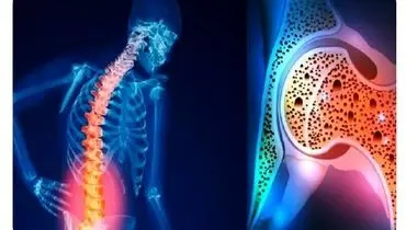 برای افزایش تراکم استخوان چه بخوریم؟
