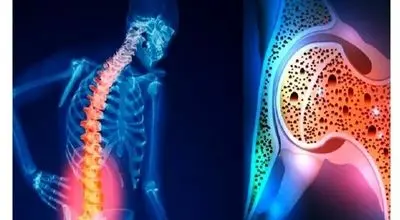 برای افزایش تراکم استخوان چه بخوریم؟