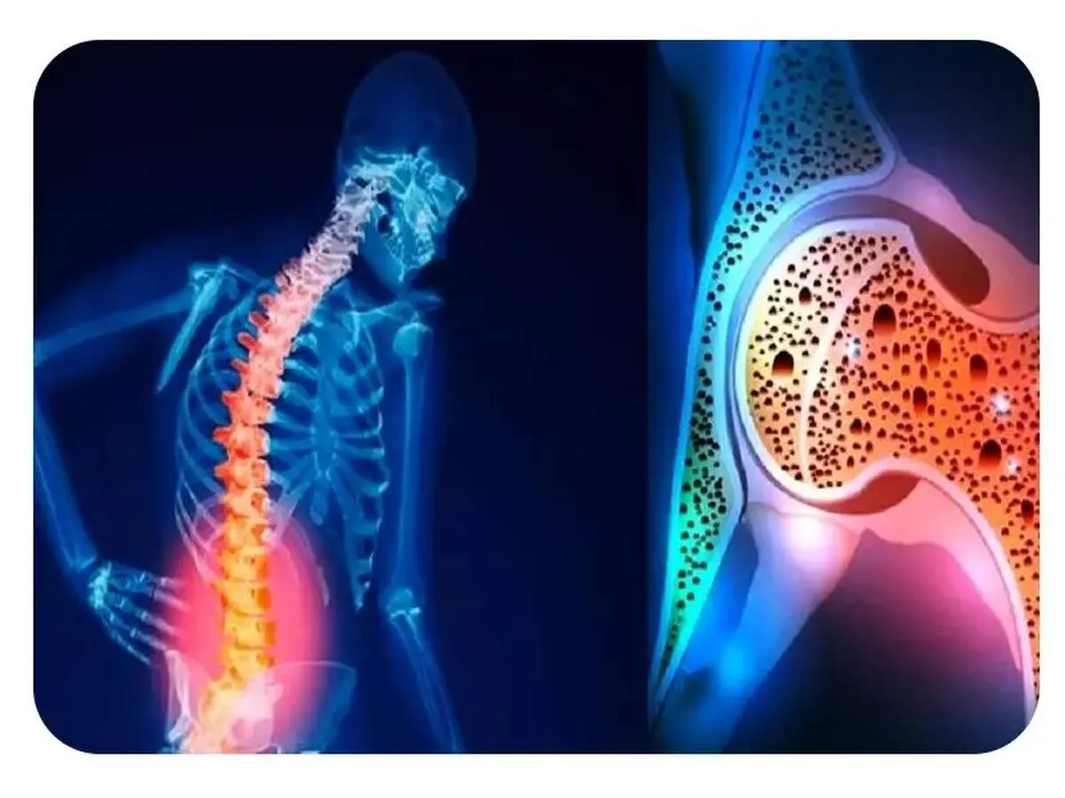 برای افزایش تراکم استخوان چه بخوریم؟
