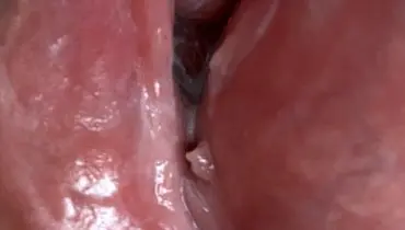 بهترین راهکار های درمان زگیل تناسلی