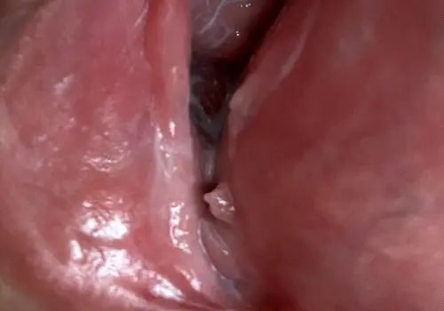 بهترین راهکار های درمان زگیل تناسلی