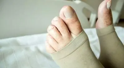 علائم هشداردهنده لخته‌ شدن خون در پا را بشناسید