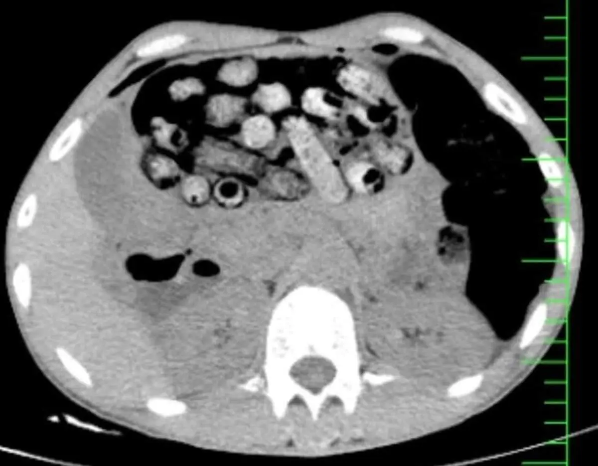 خروج ۹۰ بسته مواد مخدر از معده و روده یک بیمار در کرج