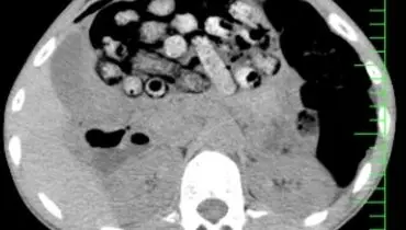 خروج ۹۰ بسته مواد مخدر از معده و روده یک بیمار در کرج