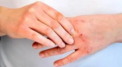 چطور اگزما را مهار کنیم؟
