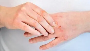 چطور اگزما را مهار کنیم؟