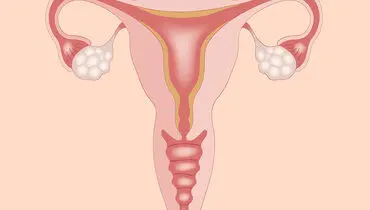 سندرم تخمدان پلی کیستیک چیست؟
