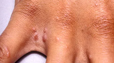 فرق بیماری گال و اگزما در چیست؟ +عکس