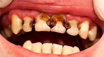 علت پوسیدگی دندان چیست؟
