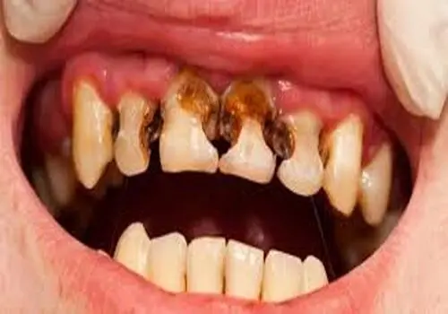  خواص دارچین برای سرماخوردگی و آنفولانزا