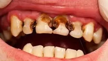 علت پوسیدگی دندان چیست؟

