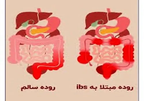 با سندروم روده تحریک‌پذیر بیش‌تر آشنا شوید