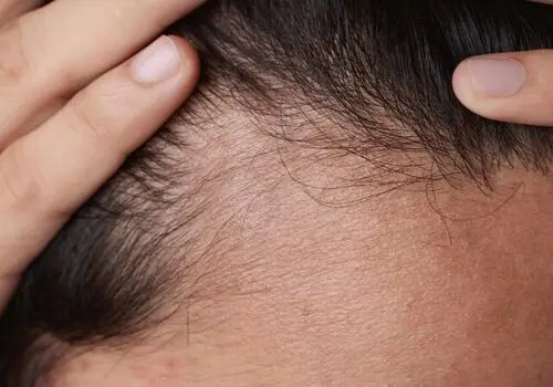 با این غذاها دچار ریزش مو می شوید