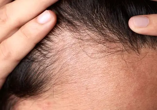 ریزش مو چه زمانی غیرطبیعی است؟