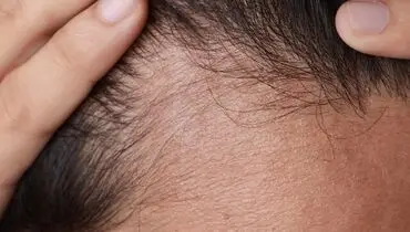 ۶ دلیل که سبب ریزش موها می‌شود