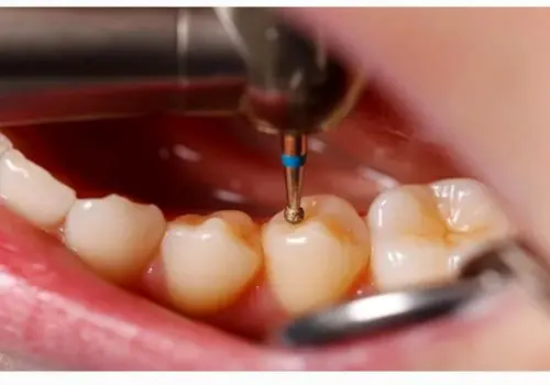 ۶ راه طبیعی برای درمان پوسیدگی دندان بدون پرکردن