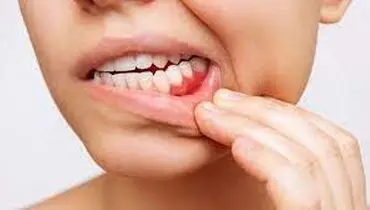 دلیل درد لثه و فک پایین چیست؟

