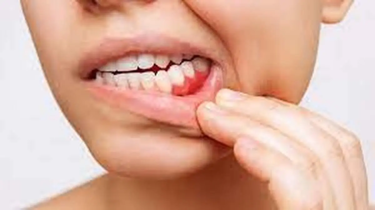 دلیل درد لثه و فک پایین چیست؟
