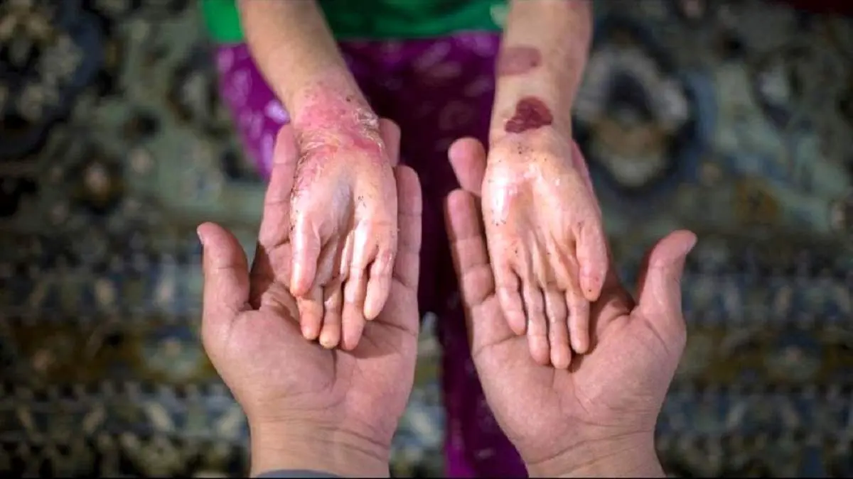 امید تازه برای بیماران پروانه‌ای + اینفوگرافیک
