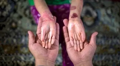 امید تازه برای بیماران پروانه‌ای + اینفوگرافیک
