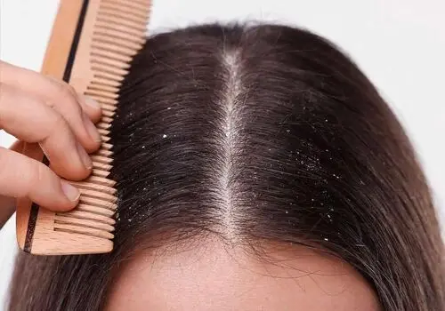 چه زمانی شوره سر می تواند خطرناک باشد؟

