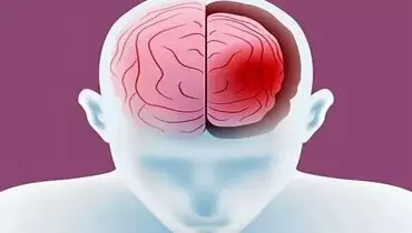 چه کسانی در معرض خطر کوچک شدن مغز هستند؟