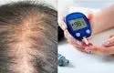 دیابت با ریزش مو چه ارتباطی دارد؟