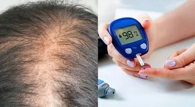 دیابت با ریزش مو چه ارتباطی دارد؟