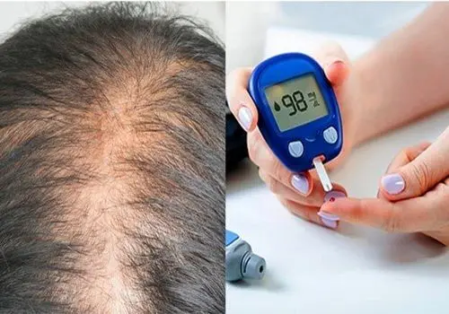 دیابت با ریزش مو چه ارتباطی دارد؟