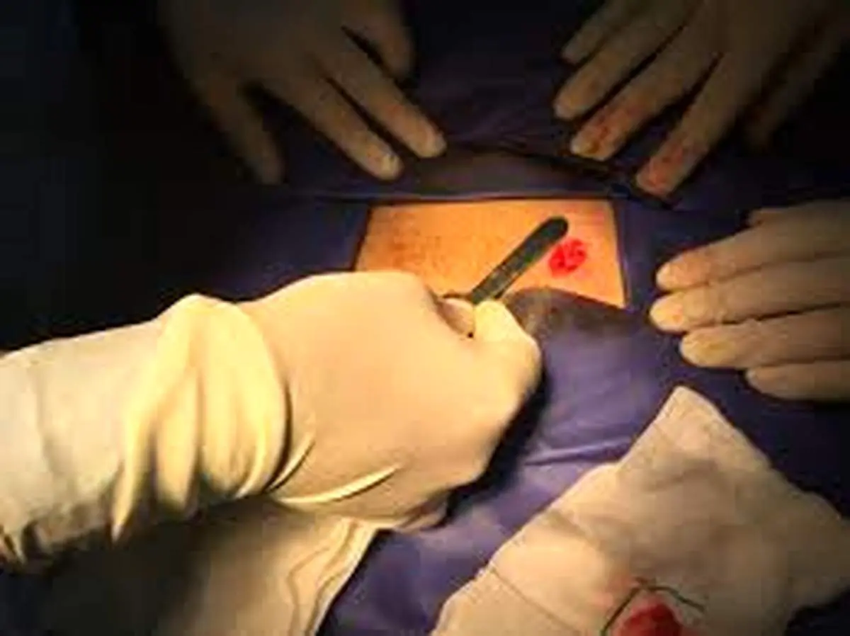 توصیه های بعد از عمل واریکوسل
