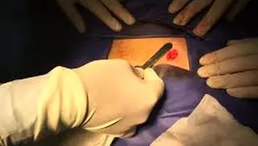 توصیه های بعد از عمل واریکوسل
