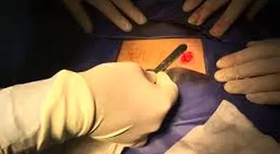 توصیه های بعد از عمل واریکوسل
