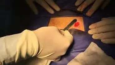 توصیه های بعد از عمل واریکوسل
